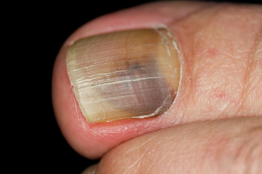 Close-up of a fingernail with a discolored, uneven surface showing a combination of yellow and grayish tones, and visible ridges.