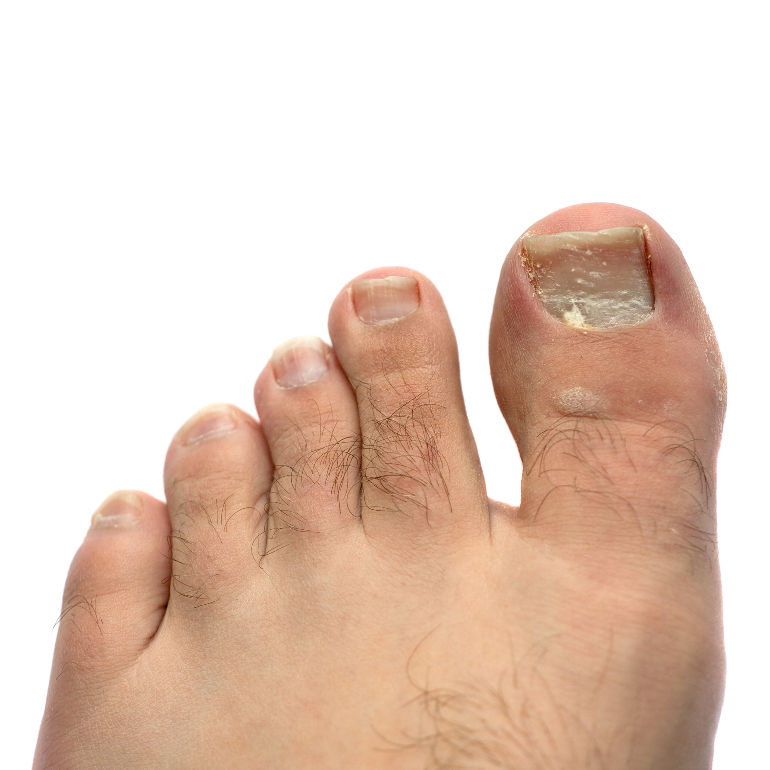 A close-up of a foot showing five toes, with the focus on the big toe, which has an irregularly shaped and discolored nail. The skin appears slightly tanned, and there is visible hair on the toes. The background is white.