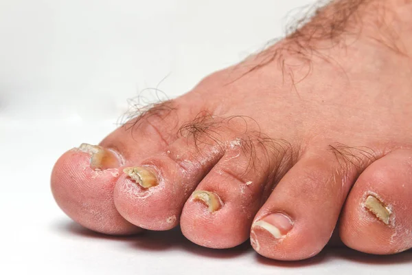 Close-up of a hairy foot with several toenails appearing damaged and discolored.